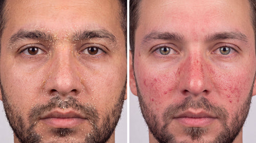 Seborrheic Dermatitis vs. Rosacea: Key Differences in Facial Redness