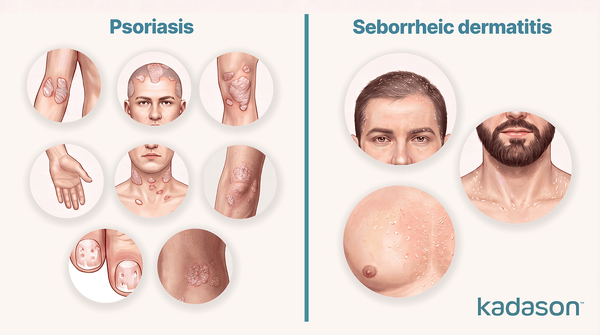 Psoriasis or Seborrheic Dermatitis? A Symptom-by-Symptom Comparison