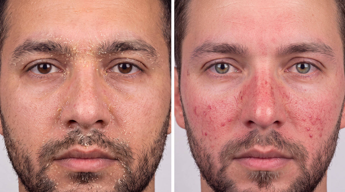 Seborrheic Dermatitis vs. Rosacea: Key Differences in Facial Redness
