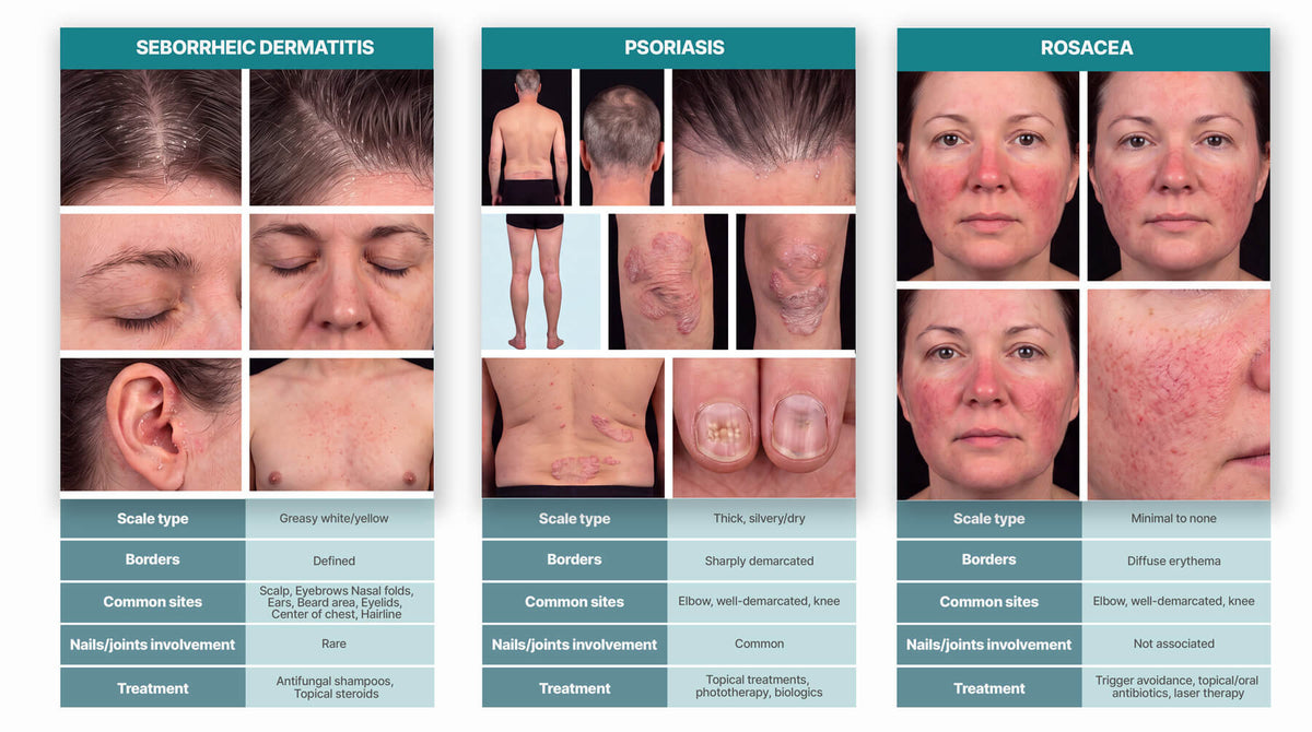 Seborrheic Dermatitis vs. Psoriasis: The Complete Comparison Guide