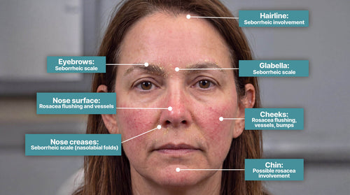 Seborrheic Dermatitis vs. Rosacea on the Face: A Location-Based Guide
