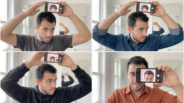 Visual Guide: Understanding Hair Loss With Seborrheic Dermatitis